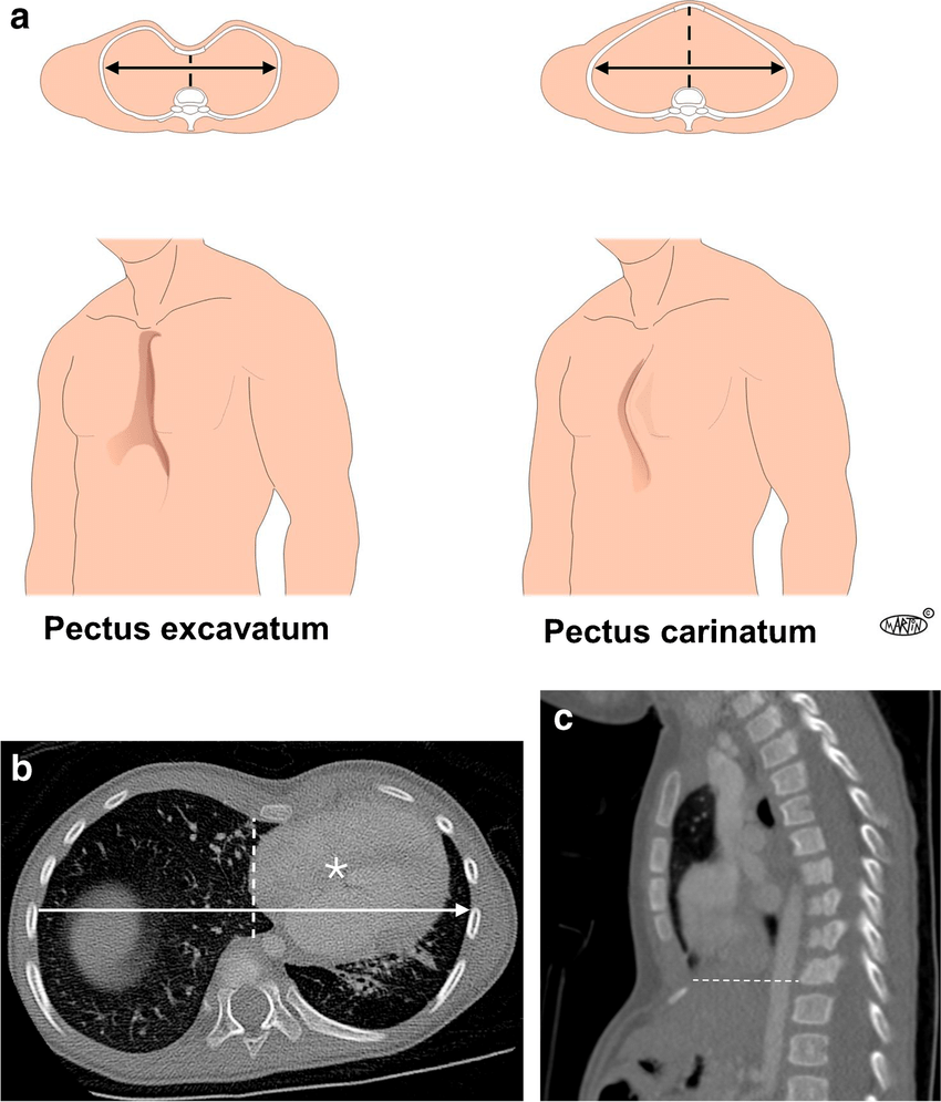 Illustration comparing pectus excavatum (concave chest) and pectus carinatum (pigeon chest) with labeled diagrams of both conditions and CT scan images.